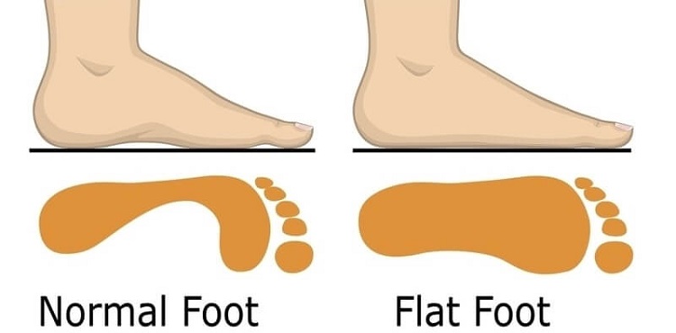 Who Should Need Orthotic Insoles Who Should Need Orthotic Insoles