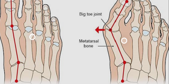 What Are the Causes Factors of Bunions?